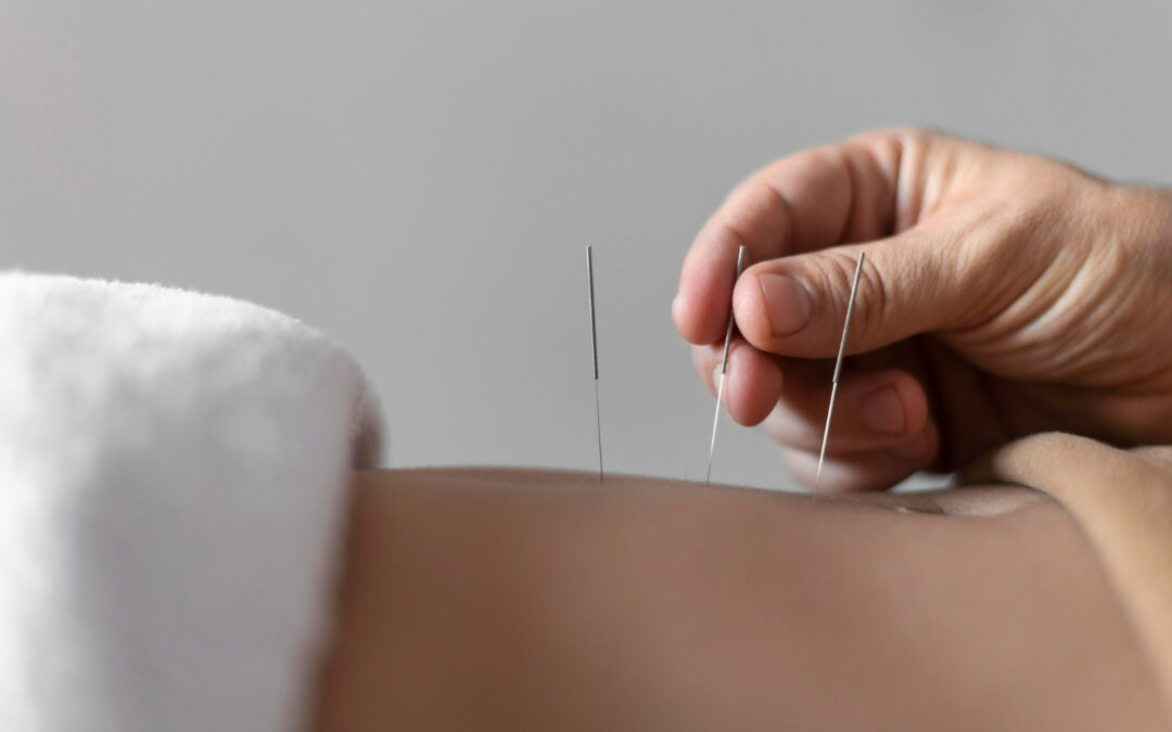 A Prick that Heals The Connection Between Dry Needling and Acupuncture